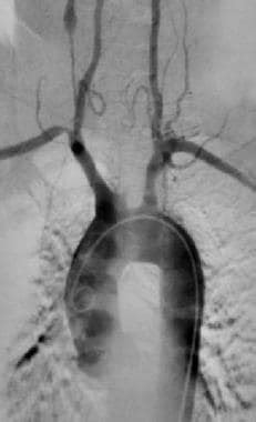 Takayasu Arteritis: Practice Essentials, Background, Pathophysiology