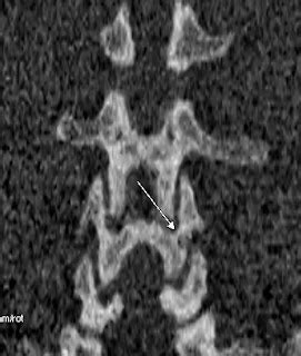 Osteoid Osteoma-Posterior Element Lumbar Spine - Sumer's Radiology Blog