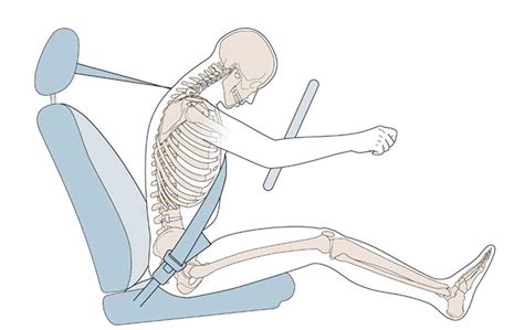 Car Seat Belt Injury - Access IPC