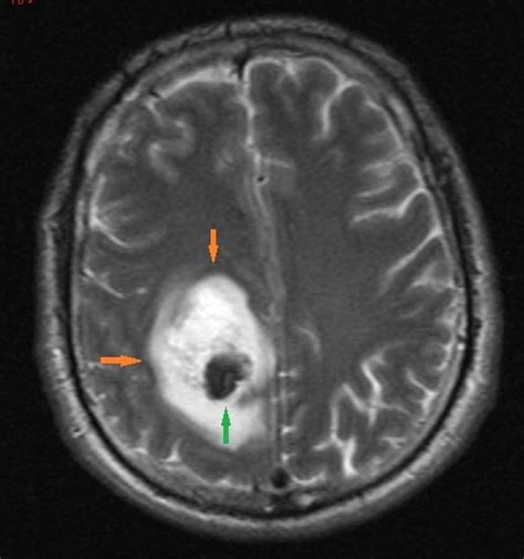 Parietal Lobe and Pathology