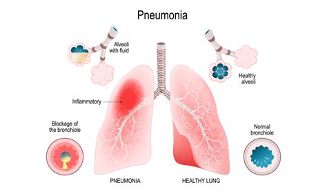 Risk factors related to Pneumonia | HHC