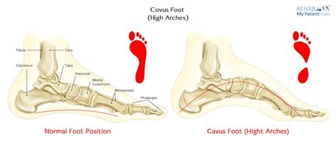 Cavus Foot (High Arches) | Rehab My Patient