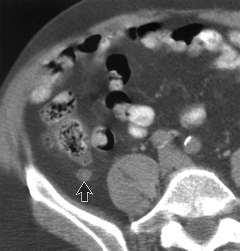 Chronic Inflammatory Appendiceal Conditions That Mimic Acute ...