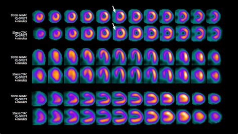 SPECT/CT overcomes breast-attenuation artifact for improved specificity in 4-minute MPI study ...