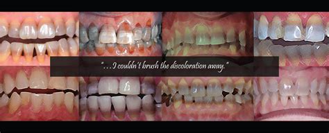 Intrinsic Vs. Extrinsic Staining | Children of Tetracycline Teeth Staining