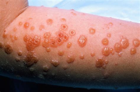 Erythema multiforme causes, types, symptoms, diagnosis and treatment