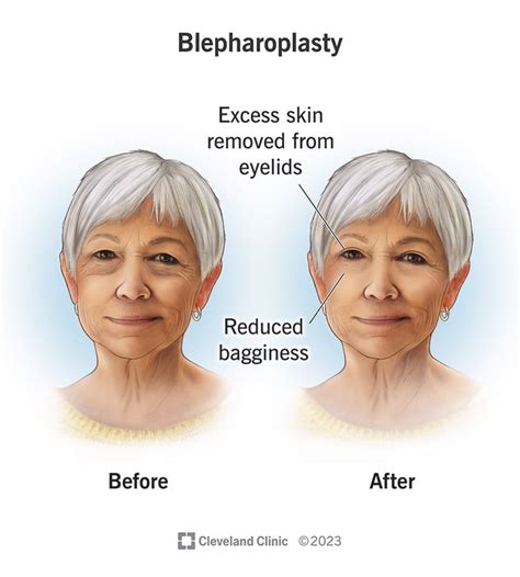 Blepharoplasty (Eyelid Surgery): What It Is, Details & Recovery