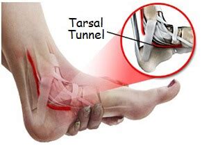 Foot Arch Pain: Causes & Treatment For Bottom Of Foot Pain