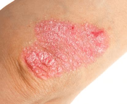 Psoriasis - Walk-in Dermatology