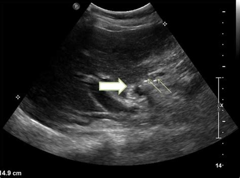 Porcelain gallbladder. Ultrasound image showing contracted gallbladder... | Download Scientific ...