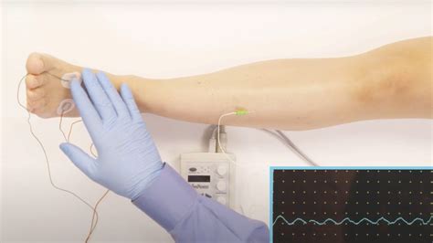 EMG Needle Exam - Tibialis Anterior (TA) - CloudEMG