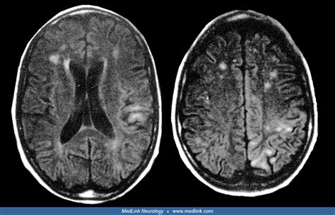 Cerebral vasculitis presenting with dementia | MedLink Neurology