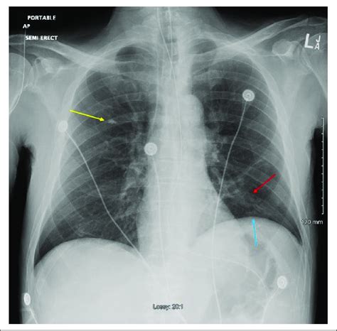 Chest x-ray taken on admission showing left basilar atelectasis (red... | Download Scientific ...