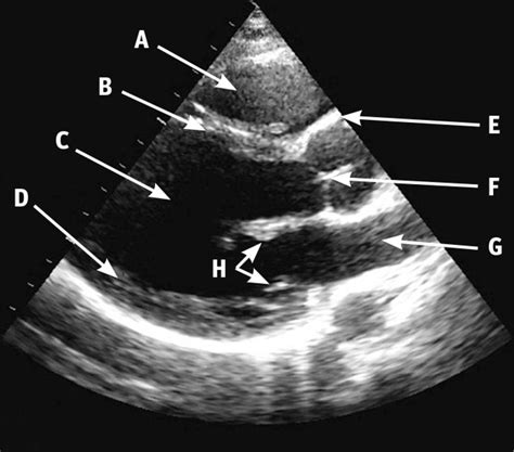 Transthoracic echocardiogram in a parasternal long axis window | The BMJ