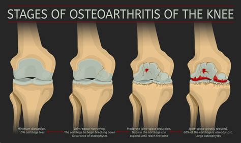 Progression And Possible Complications Of Osteoarthritis Oa Painscale ...