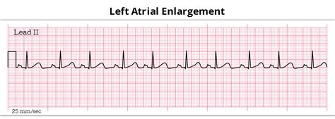 What You Must Know About Left Atrial enlargement?