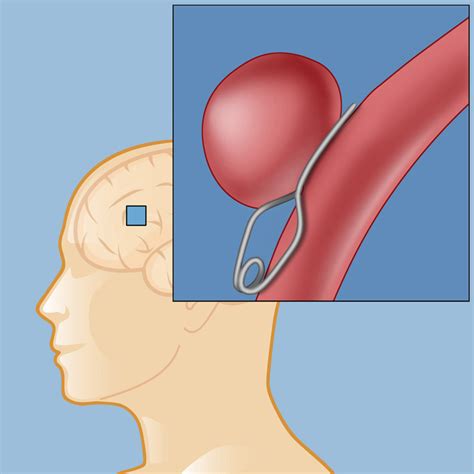 Surgery for Aneurysm | Weill Cornell Brain and Spine Center