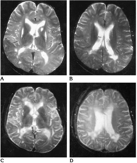 A 15-year-old boy with a 22month history of SSPE, clinical stage ...