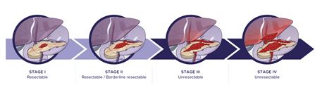 How is the extent of pancreatic cancer assessed (staging)? - Pancreatica.org