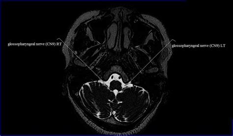 Cranial Nerves Mri