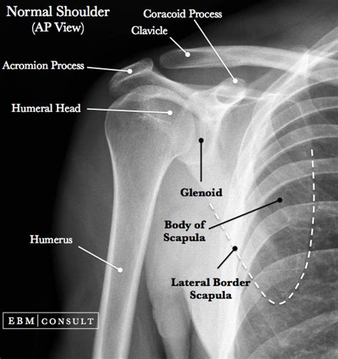 Anterior Shoulder Dislocation - General Review