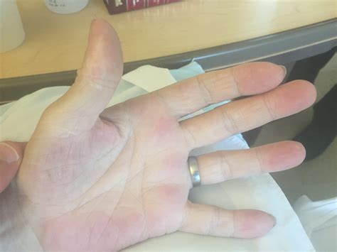 Palmar Erythema - Physical Diagnosis PDX