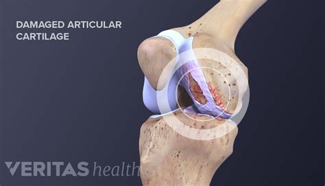 Can Damaged Cartilage Be Fixed? | Sports-health
