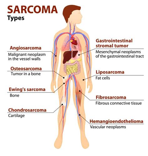 Sarcoma Cancer (Soft Tissue & Bone) - Deaf Cancer Support Group