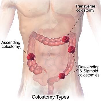 Perforated Bowels: Causes, Symptoms & Treatment | Study.com