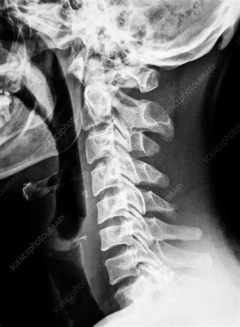 Normal Cervical Spine, X-Ray - Stock Image - C039/3923 - Science Photo ...