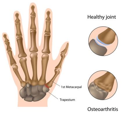 Pain in Base of Thumb: Convincing a Skeptic - Regenexx Blog