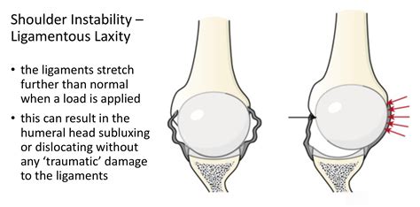 Fig 9. Ligamentous Laxity Instability - lax capsular ligaments allow ...