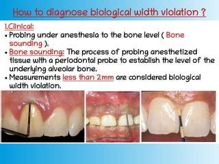 Biological width | PPT