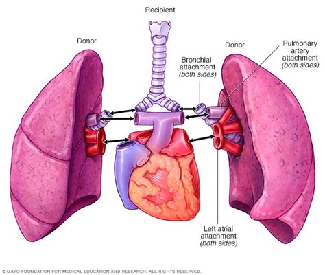 Lung transplant - Mayo Clinic