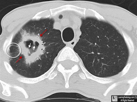 Squamous And Adenocarcinoma Lung Cancer