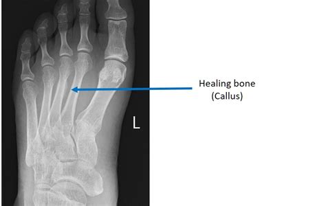 Stress Fracture Singapore Treatment | Foot Surgeon | Relieve Leg Pain