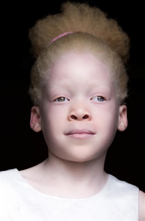 Albino Black Human