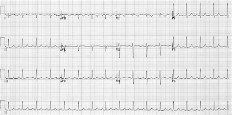 Supraventricular Tachycardia (SVT) • LITFL • ECG Library Diagnosis