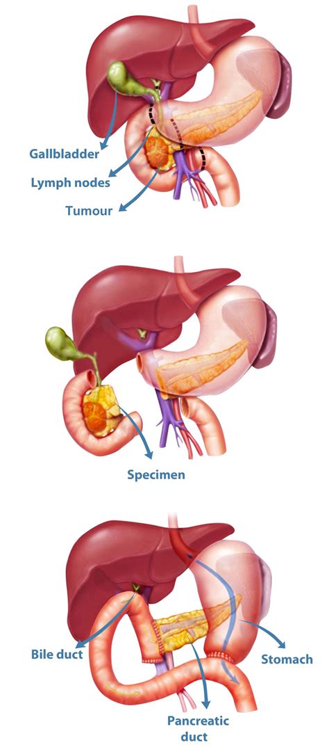 Pancreas Surgery or Pancreatectomy Perth | Pancreatic disorders Perth