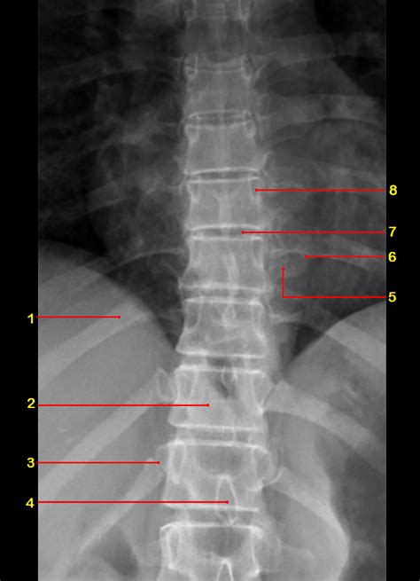 Thoracic Spine Radiographic Anatomy Wikiradiography | Images and Photos finder