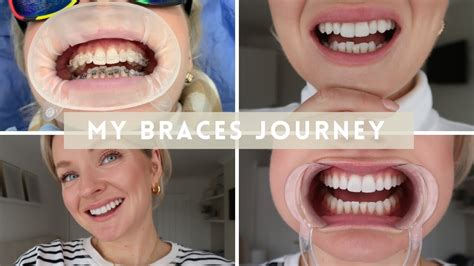 Ceramic Braces Before And After