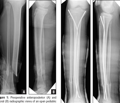 Figure 1 from Outcomes using titanium elastic nails for open and closed pediatric tibia ...