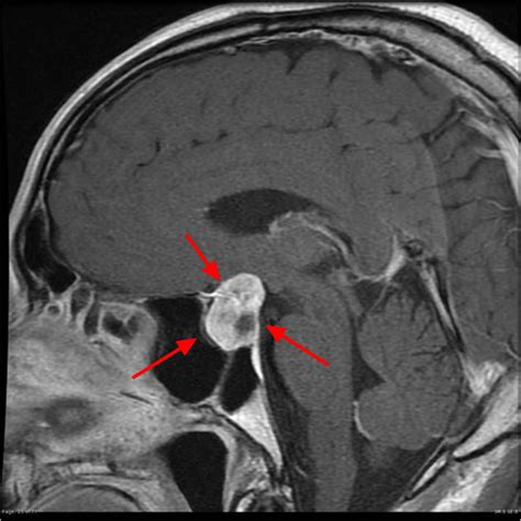 Pituitary Tumor - Signs, Symptoms, Diagnosis, MRI, Surgery & Treatment