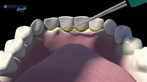 Dental Scaling - تقليح الاسنان - YouTube