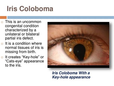 Abnormalities of pupil