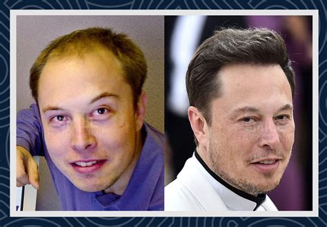 Elon Musk Haartransplantation - Smile Hair