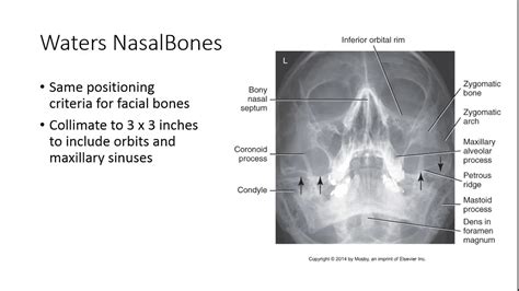 Radiographic Positioning of the Nasal Bones - YouTube