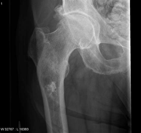 Chondrosarcoma - Physiopedia