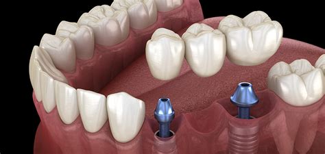 Best Dental Implants in Delhi