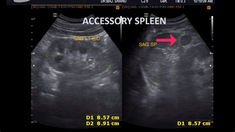 Ultrasound cases 285 of 2000 || Accessory Spleen Splenomegaly - YouTube